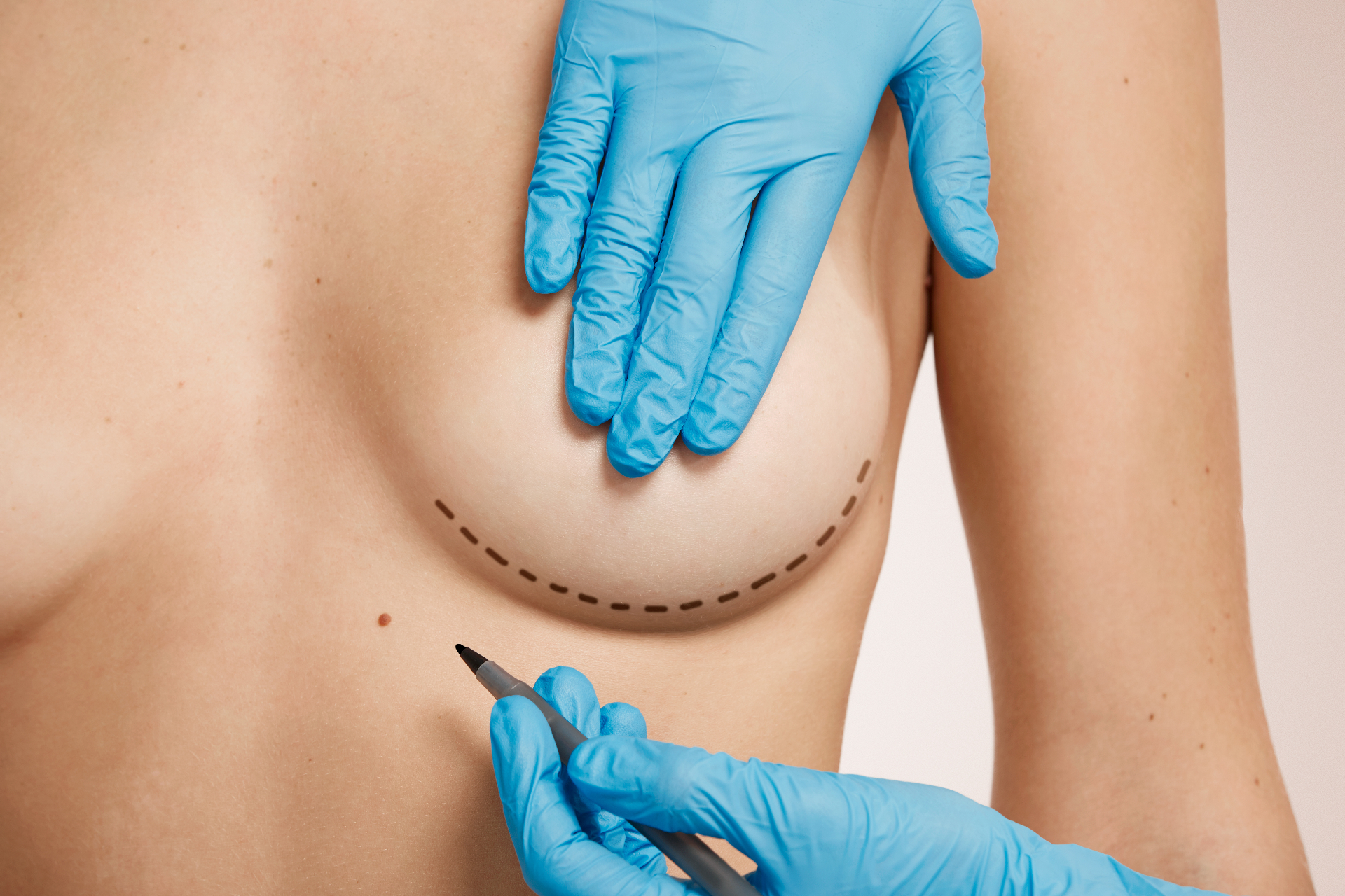 Brustvergrösserung mit Eigenfett – Lipofilling Zürich